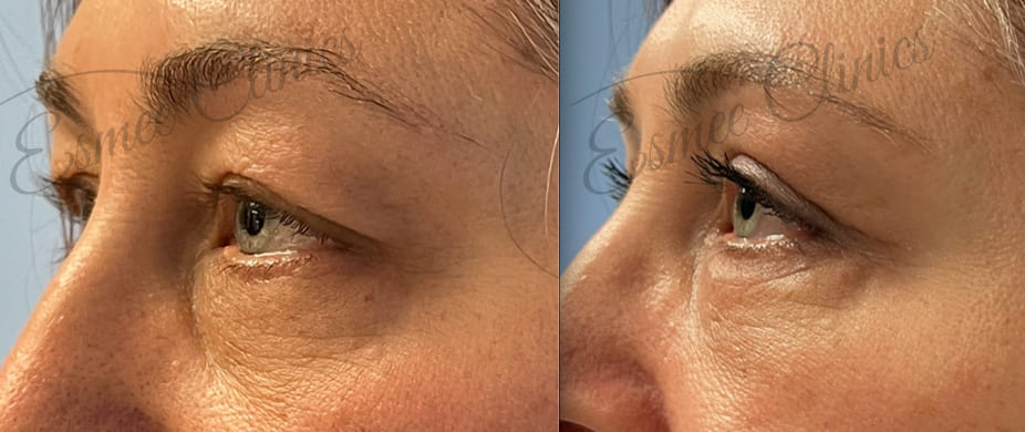 Before and After img